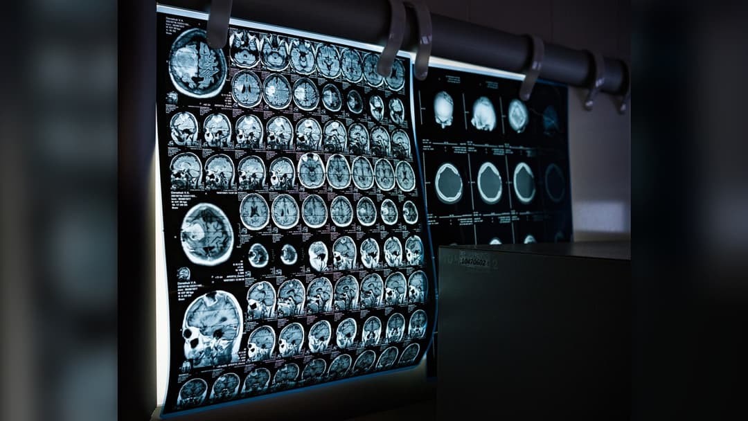 Landscape photograph of neurological brain MRI scans on a medical display