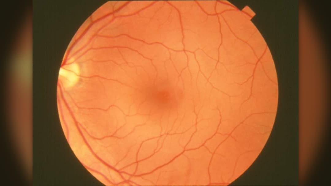 4. Optic Nerve Cellular Health