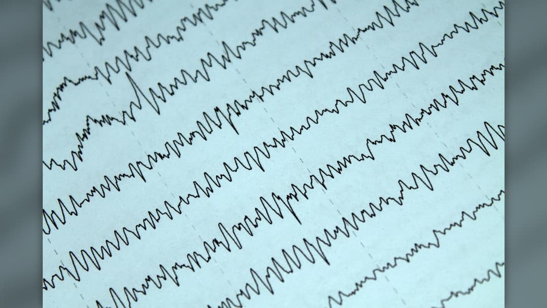 3. Massive Neurological Seizures