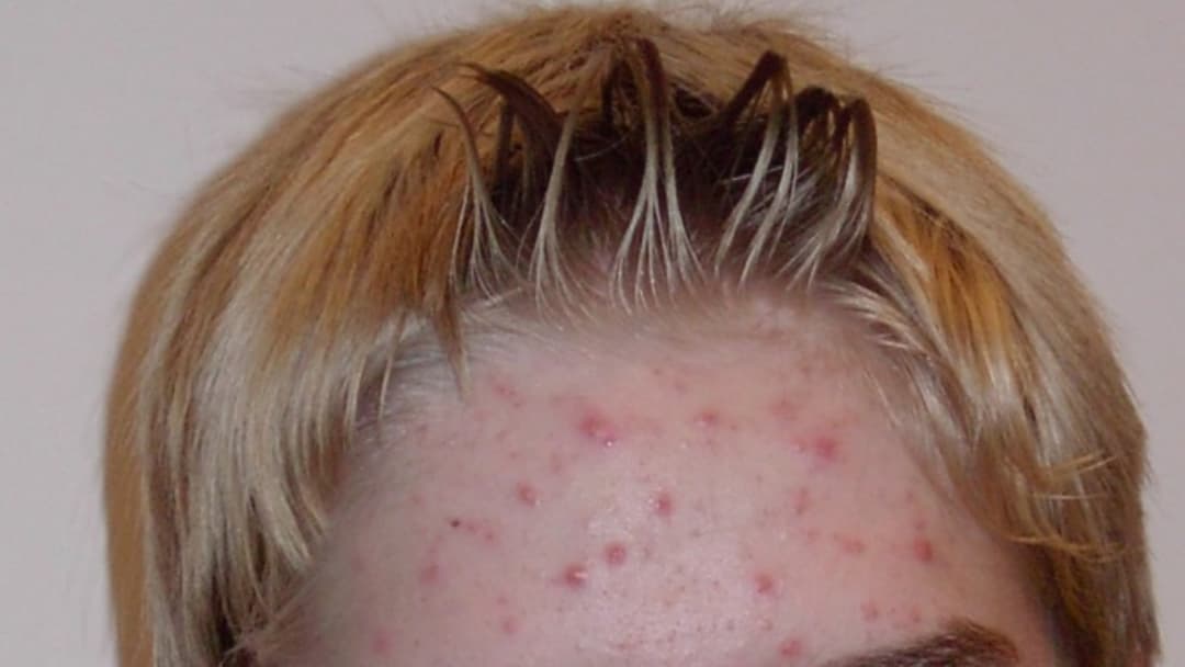 15. Spot-Treat Active Breakouts Directly