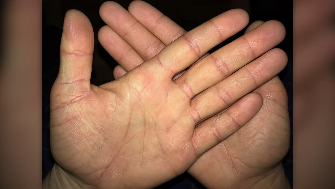 25. Ireland: Itchy Palms