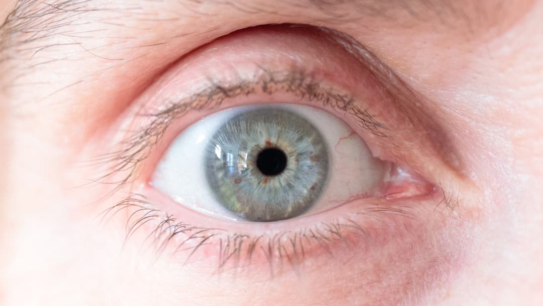 16. Grey Eyes And Dense Stroma Collagen