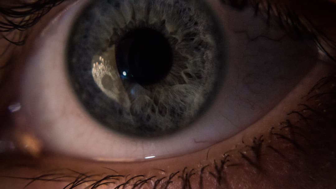 7. Blue Eyes And Lower Incidence Of Vitiligo