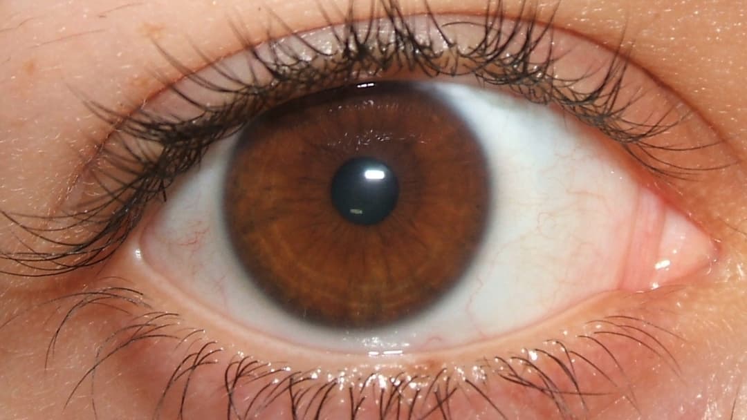 18. Central Heterochromia And Distinct Color Halos